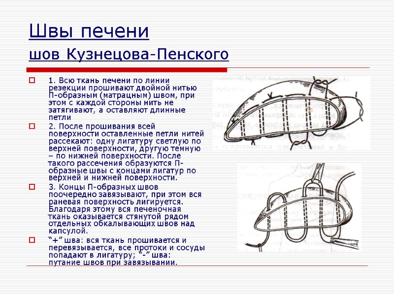 Швы печени шов Кузнецова-Пенского  1. Всю ткань печени по линии резекции прошивают двойной